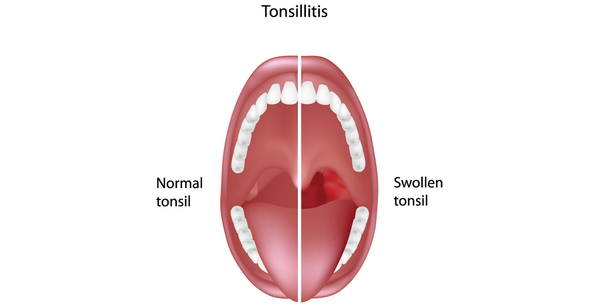 Diagram-of-tonsillitis