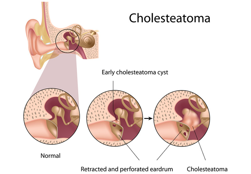 illustration-of-cholesteatoma