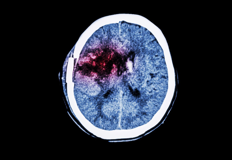 Skull Base Tumors ENT Doctor Cochlear Implant Surgeon Harrison Lin MD
