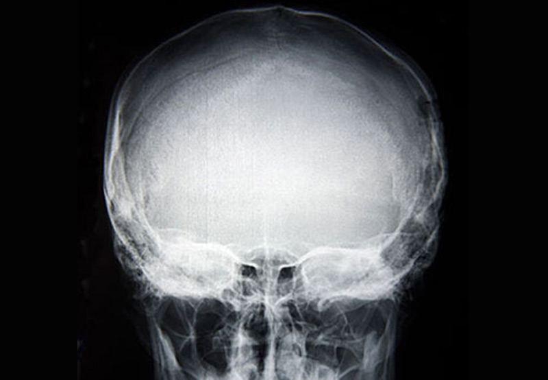 x-ray-of-skull-base